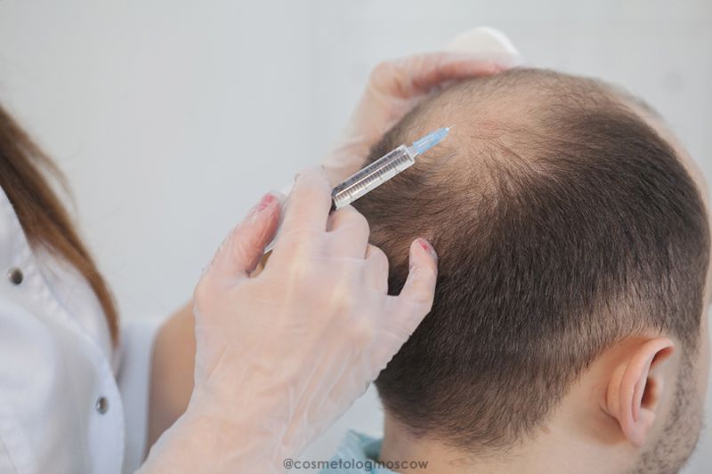 Мезотерапия для волос москва. Мезо волосистой части головы. Плазмолифтинг волосистой части головы. Мезотерапия для волос. Мезотерапия кожи головы.